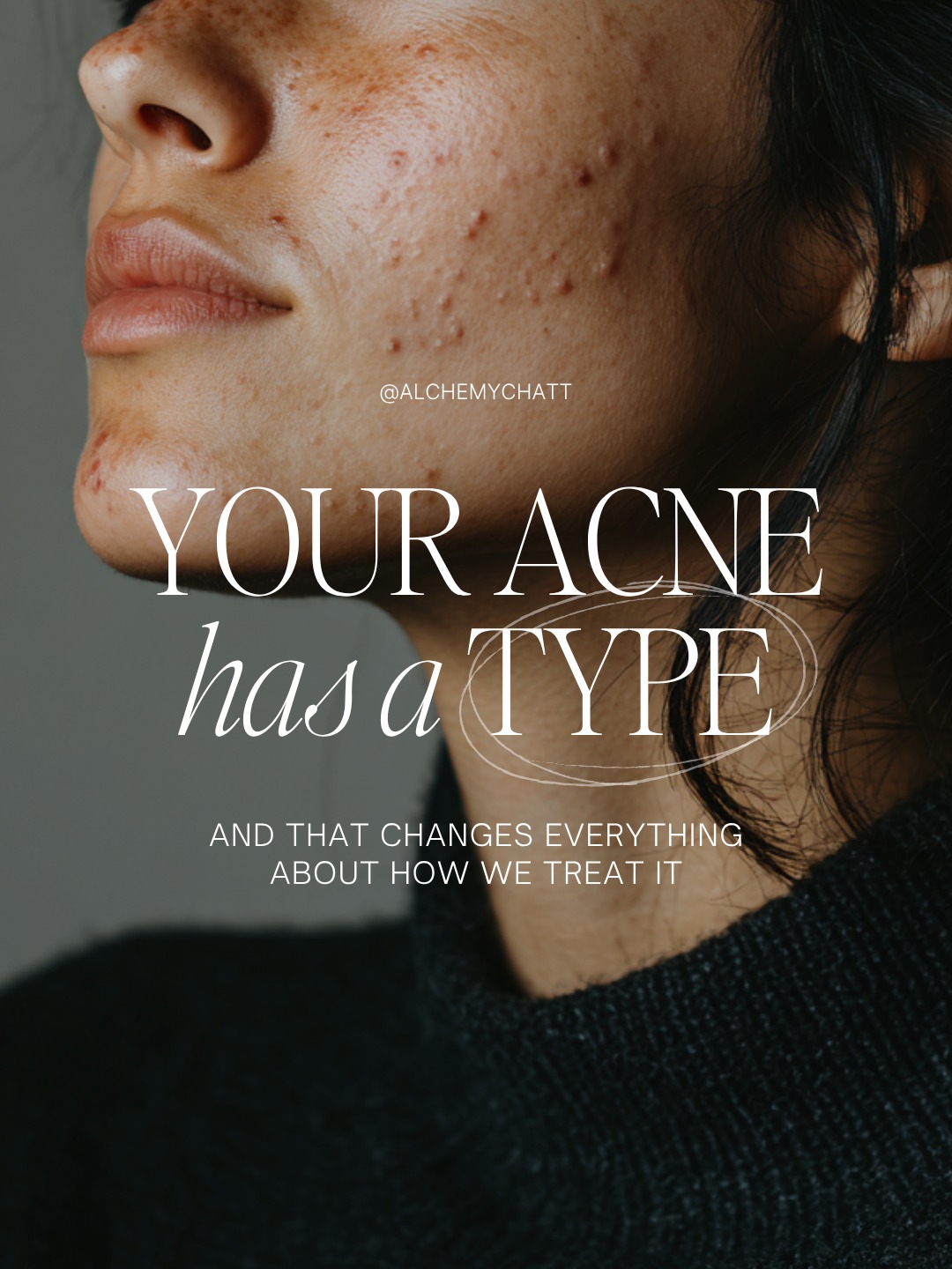 Acne can affect teenagers and adults alike, but successful treatment starts with understanding what type of acne you're experiencing.

At Alchemy MedSpa & Wellness Center, we help patients struggling with:
✔ Hormonal Acne
✔ Adult Acne
✔ Teen Acne
✔ Cystic Acne
✔ Blackheads & Whiteheads
✔ Acne Scarring
✔ Sensitive Acne-Prone Skin

Our acne specialists create personalized treatment plans using advanced skincare solutions, medical-grade skincare products, chemical peels, acne facials, and skin health assessments.

📞 Schedule your consultation today and start your clear skin journey.

#AcneSpecialistNearMe #AcneTreatmentChattanooga #AcneTreatmentClevelandTN #HormonalAcneTreatment #CysticAcneTreatment #AcneScars #MedicalGradeSkincare #SkinHealth #ClearSkinJourney #BestMedSpaChattanooga #BestMedSpaClevelandTN #AlchemyMedSpa