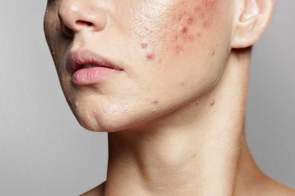 woman with cystic acne